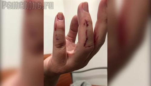 В Красноярском крае на вызове к пациенту врача покусала собака